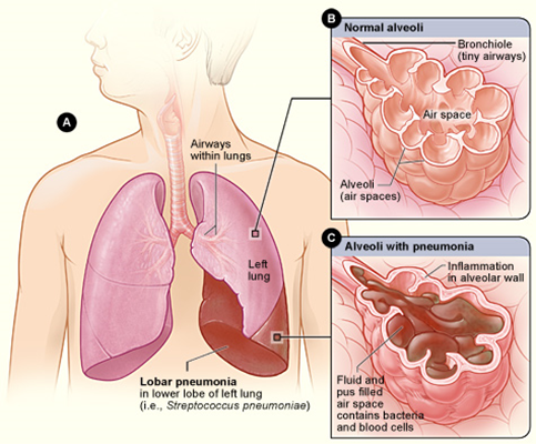 pneumonia